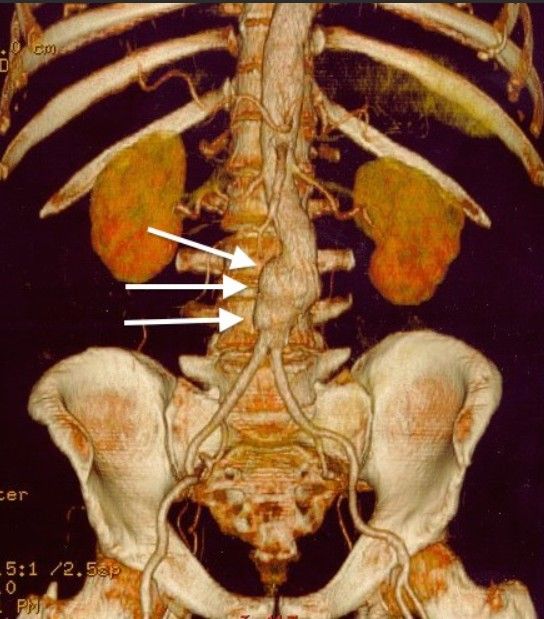 ภาพ CT Scan แบบสามมิติ แสดงให้เห็นเส้นเลือดโปงพองในช่องท้อง