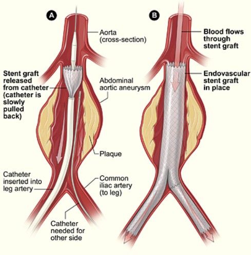 การเสริมความแข็งแรงให้เก็บหลอดเลือดแดงช่องท้องที่โป่งพองด้วยสเต็นท์ผ่านการสวนหลอดเลือด