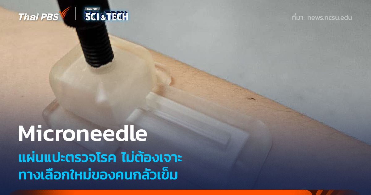 แผ่นแปะ Microneedle ตรวจหาโรคแบบไม่เจาะเลือด ทางเลือกใหม่ของคนกลัวเข็ม