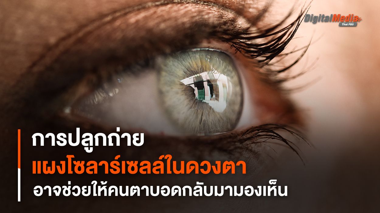 การปลูกถ่าย "แผงโซลาร์เซลล์" ในดวงตา อาจช่วยให้คนตาบอดกลับมามองเห็น