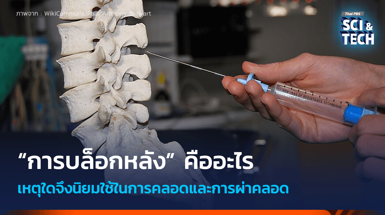 “บล็อกหลัง” คืออะไร ทำไมจึงนิยมใช้ระหว่างการคลอด